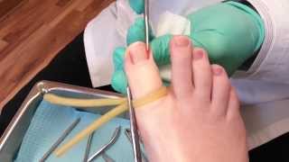 Ingrown toenail surgery [upl. by Ellerrad227]