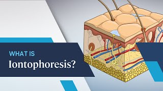 What is Iontophoresis [upl. by Lynna]