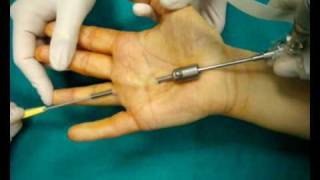 Endoscopic trigger finger [upl. by Rutter]