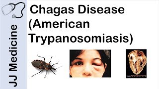 Chagas Disease  American Trypanosomiasis  Causes Symptoms and Treatment [upl. by Riatsila]