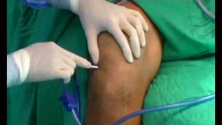 Septic arthritis of the knee arthroscopic debridement [upl. by Eimas22]