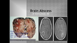 Brain Abscess [upl. by Neeleuqcaj]