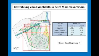 Bestrahlung vom Lymphabflussgebiet beim Mammakarzinom  Strahlentherapie Prof Hilke Vorwerk [upl. by Annaor]