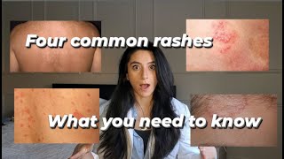 Four common rashes and everything you need to know about them [upl. by Biel]