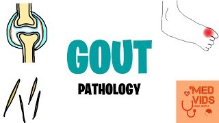 HOW LONG DOES A GOUT ATTACK LAST [upl. by Nitz]