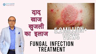 फ़ंगस इनफ़ेक्शन दिनाय दाद खाज का इलाज  Treating Fungal Infection In HINDI  Dr Rohit Batra [upl. by Gherlein]