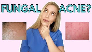 Do YOU have Fungal Acne  Dermatologist Talks Symptoms and Treatments [upl. by Drofxer687]