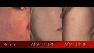 IPL Photofacial Review After 4 Treatments  Before amp After [upl. by Ashelman]