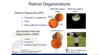 A Stem CellBased Therapy for Retinitis Pigmentosa [upl. by Sholley11]