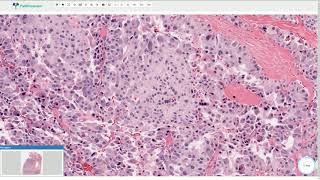 Medullary Carcinoma  Thyroid Gland Histopathology [upl. by Hamimej]