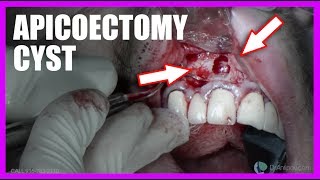 Apicoectomy Cyst SURGERY [upl. by Jarlen]