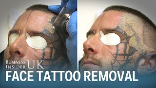 Watch This Man Have His Face Tattoo Removed From Laser Surgery  Business Insider [upl. by Liw]