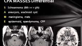 Cerebellopontine Angle Lesions [upl. by Fagen]