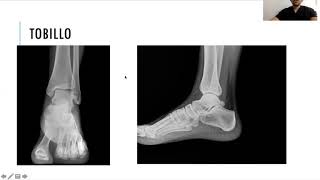 Radiología simple de miembro inferior [upl. by Sudhir678]