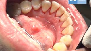 Periodontal treatment protocol [upl. by Vanden]