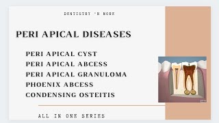 DISEASES OF PERIAPICAL TISSUE [upl. by Woermer]