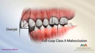 Malocclusion  Class II Div I [upl. by Layla]