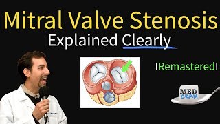 Mitral Valve Stenosis Made Easy [upl. by Alcock]