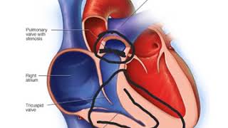 Pulmonary Stenosis [upl. by Maffa32]