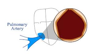 Pulmonary Stenosis [upl. by Namijneb]