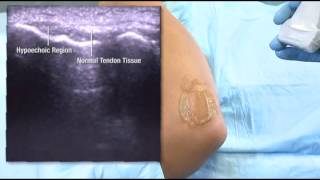 Ultrasound Diagnosis Lateral Epicondyle [upl. by Issiah]