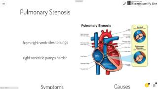 Stenosis and Pulmonary Stenosis [upl. by Edi]