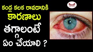 కండ్ల కలక తగ్గాలంటే  Conjunctivitis  Kalla Kalaka  Eagle Health [upl. by Lauretta]