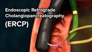 Dilatation and Evacuation Procedure D amp E [upl. by Denman]