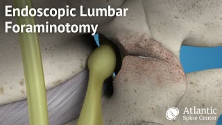 Endoscopic Lumbar Foraminotomy [upl. by Enelrae884]