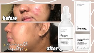 i used THE ORDINARY NIACINAMIDE 10  ZINC 1 serum for 1 MONTH review [upl. by Atteiram994]