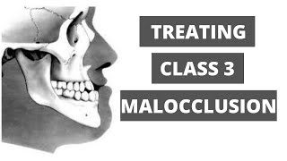 Management of Class 3 Malocclusion Orthodontics [upl. by Synned]