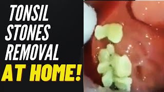 Tonsil Stones Removal Causes and Treatment [upl. by Dot619]