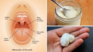 Tonsil Stones Removal Techniques [upl. by Viveca941]