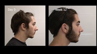 Minoxidil Beard Growth  3 Month Transformation  Timelapse BEFORE and AFTER [upl. by Sauers]