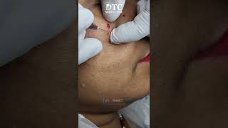 Milia Extraction Procedure  DTC Skin Clinic [upl. by Zorina678]