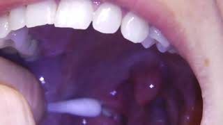 Tonsil Stones Removal At Home 2021  Remove Tonsil Stones Quickly At Home [upl. by Thornburg]