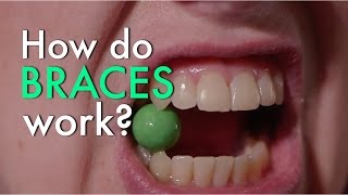 How Do Braces Work [upl. by Audie]