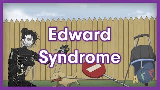 Edward Syndrome Trisomy 18  USMLE Step 1 Mnemonic [upl. by Samau730]