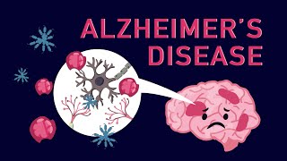 Alzheimer Die häufigste From von Demenz  Stiftung Gesundheitswissen [upl. by Aid31]