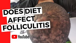 Folliculitis  Does diet affect folliculitis [upl. by Leik685]