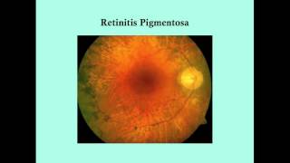 Retinitis Pigmentosa  CRASH Medical Review Series [upl. by Eniluqaj]