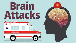 Intro to Head CT Part II Evaluation of Ischemic Stroke [upl. by Annairda]