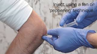 Injection Technique for Lateral Epicondylalgia [upl. by Argus164]