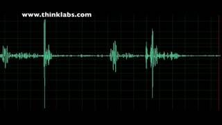 Pulmonary Stenosis mild [upl. by Behrens473]