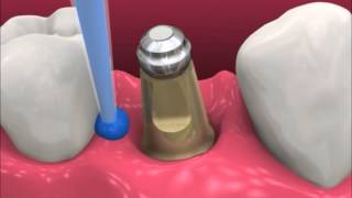 Smyl Manatee  Dental Implant Procedure [upl. by Arta]