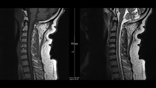 Spinal Cord Mnemonics Memorable Neurology Lecture 8 [upl. by Einaej417]