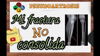 Fractura que no consolida  Pseudoartrosis [upl. by Herzog456]