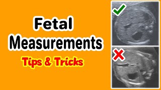 Fetal Measurements Tips and Tricks [upl. by Hannad]