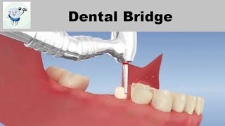 Dental Bridge Animation 3D [upl. by Timi]