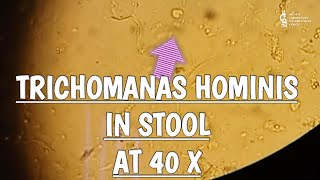 Trichomonas Hominis in stool microscopy at 40X [upl. by Alarise]